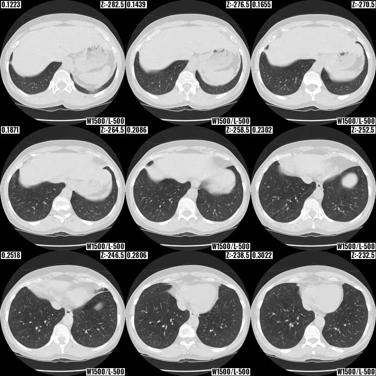 Base of lungs