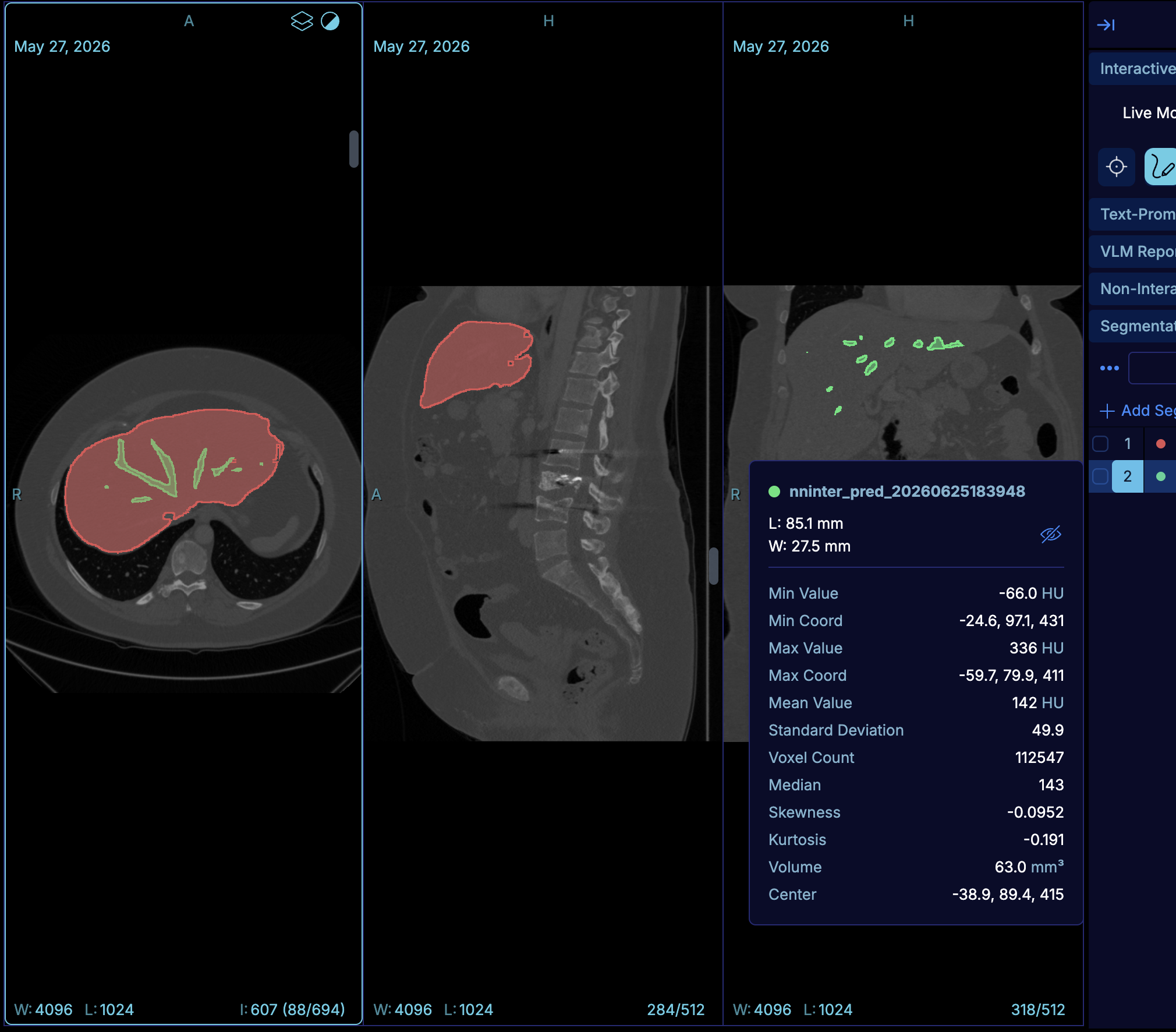 OHIF overlapping segmentations with statistics and bidirectional measurements in MPR view